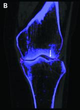 DECT image with color-coded overlay shows typical findings of CPPD along the medial and lateral menisci (arrow) and calcium in tissues where it's not usually found (e.g., hyaline cartilage).