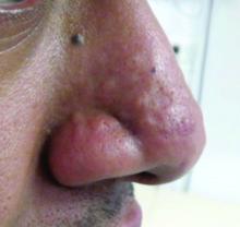 Nasal papules in a patient with a history of acne.