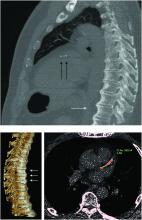 A 68-year-old male shows thoracic DISH (upper panel, white arrow) and calcifications in left anterior descending coronary artery (LAD). Lower left panel shows a 3D reconstruction of the spine showing DISH and lower right, LAD calcification quantification.