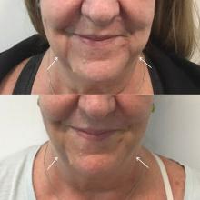 A patient before and after three deoxycholic acid treatments of the jowl overhang.