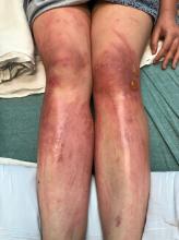 Legs with linear erythematous patches and linear bullae