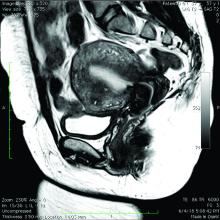 MRI image of heterogeneous myometrium