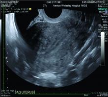 Transvaginal ultrasound of heterogeneous myometrium