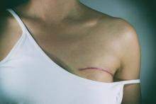 Breast cancer surgery scar