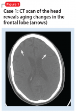 Case 1: CT scan of the head reveals aging changes in the frontal lobe (arrows)