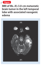 MRI of Ms. A’s 3.0-cm metastatic brain tumor in the left temporal lobe with associated vasogenic edema