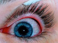 Acute conjunctivitis