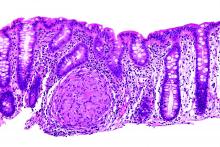 High magnification micrograph shows an H&E strain of Crohn's disease during a colon biopsy.