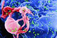 HIV-1: Scanning electron micrograph of HIV-1 buds from a cultured lymphocyte.