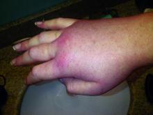 Swollen right hand in a female patient during a hereditary angioedema attack.