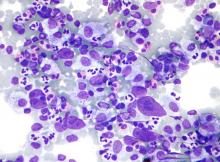 Micrograph shows stained lymph node specimen of Hodgkin lymphoma.