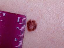 Melanoma