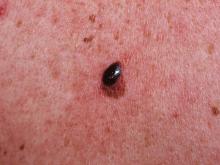 Melanoma