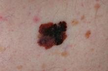 Melanoma