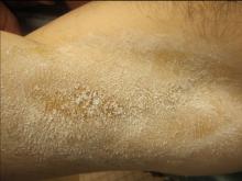 The clear axilla at 1 year post treatment shows the lack of sweating.