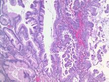 For mucinous borderline tumors, intraepithelial carcinoma has been inconclusively associated with poor prognosis.