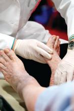 Doctor examines feet of patient with diabetes