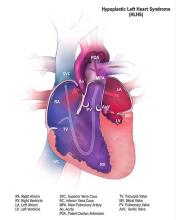 Hypoplastic left heart syndrome