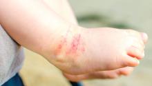 atopic dermatitis on a baby's foot