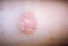 A close-up of an oval &quot;herald patch&quot; on the skin of a patient with pityriasis rosea.