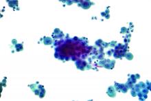  Micrograph of malignant mesothelioma, also mesothelioma. Cytopathology specimen - pleural fluid.