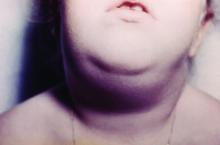 This image depicts the anterior neck of a young child, which displays the characteristic cervical swelling due to enlargement of the submaxillary salivary glands brought on by a mumps infection.