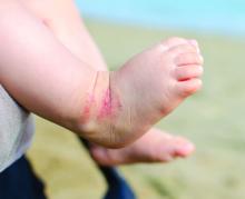 newborn feet eczema