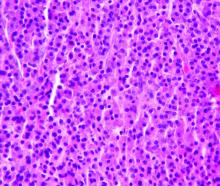 Multiple myeloma (which is diagnosed using several clinical criteria) is, histologically, a plasmacytoma.