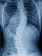 A film x-ray show a spinal bend of a teenage patient with Scoliosis.