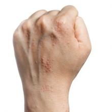 A left hand in a fist, showing atopic dermatitis