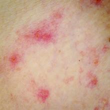 patch of skin presenting atopic dermatitis