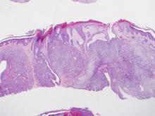 Histopathologic examination revealed an endophytic/exophytic circumscribed neoplasm extending from the epidermis to the mid reticular dermis with several lobules composed of round cells with clear cytoplasm with several scattered ducts (H&E, original magnification ×4).