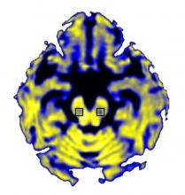 NIH-funded scientists have discovered that Parkinson's disease increases the amount of &quot;free&quot; water in the posterior substantia nigra (in squares).