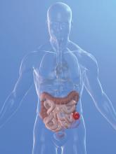 Colostomy illustration