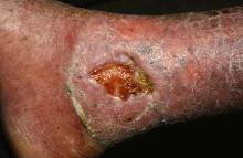 This is a venous ulcer of the leg.