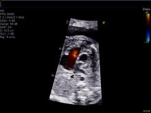 Fetal echocardiogram at 24 weeks shows hypoplastic left heart syndrome