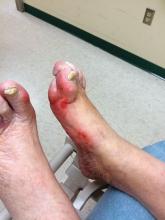 Diabetic feet need to be screened for early disease-related changes