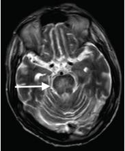 Figure 1. Axial T2-weighted magnetic resonance imaging on hospital day 5 showed a lesion with high signal intensity in the pons (arrow).