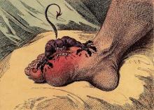 Podagra: The Gout by James Gillray (1799)