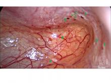 Endometriosis in the posterior cul-de-sac of a 15-year-old patient