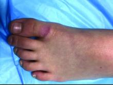 Pink annular plaque over left first toe.