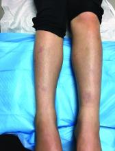 Pink round and annular plaques over shins