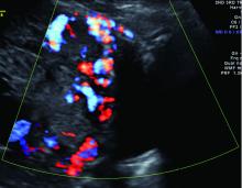 Placenta percreta shown by ultrasound.