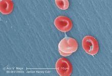 Red blood cells in a blood specimen of a 6-year-old boy with sickle cell disease