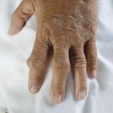A hand with gouty arthritis and tophi.