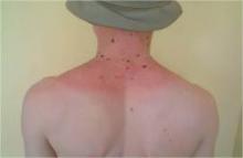 Sun Damage to Back