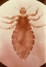 The louse can be an enormous pest to parents, schools, and physicians alike. 