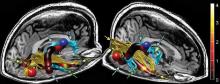 Increased fractional anisotropy in the anterior right arcuate fasciculus may serve as a biomarker for CFS.