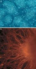  Macular degeneration patients showed increases in subretinal pigmentation after human embryonic stem cell transplantation.