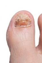 Topical efinaconazole was found to be effective regardless of presence of infection or nail thickness.